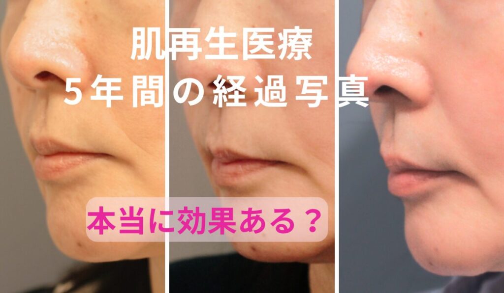 RDクリニックで受けた肌再生医療の5年間の経過比較。2021年・2023年・2026年のほうれい線の変化を比較した写真。