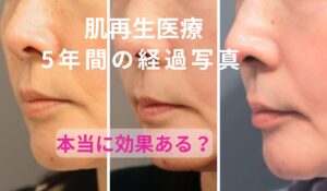 RDクリニックで受けた肌再生医療の5年間の経過比較。2021年・2023年・2026年のほうれい線の変化を比較した写真。